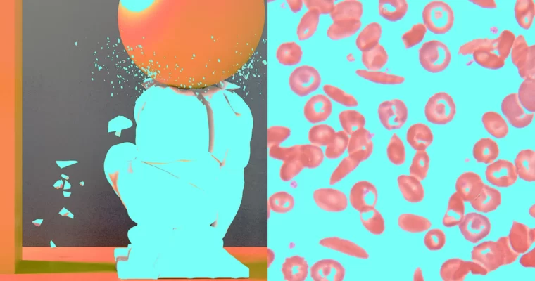 Unlocking New Horizons in Sickle Cell Anemia Care