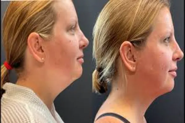 Before and After: Transforming Your Jawline with Chin CoolSculpting