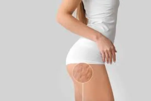 Cellulite Solutions: Say Hello to Confidence and Goodbye Dimples