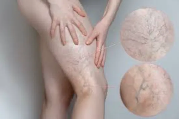 What Causes Spider Veins and How to Fix Them