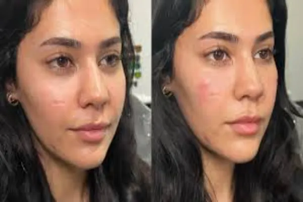 How Tear Trough Fillers Enhance Your Eyes Without Surgery?