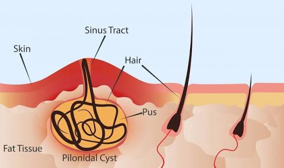 Practical Care Tips for People Dealing With Pilonidal Cyst Flare-Ups