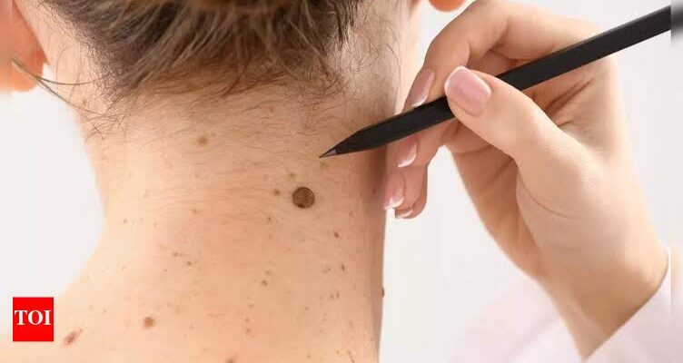The Hidden Risks of Ignoring a Suspicious Mole and When Surgery Becomes Necessary